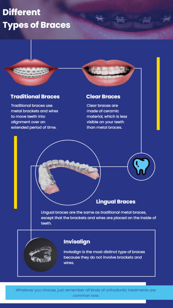 5 Main Differences between Invisalign and Lingual Braces