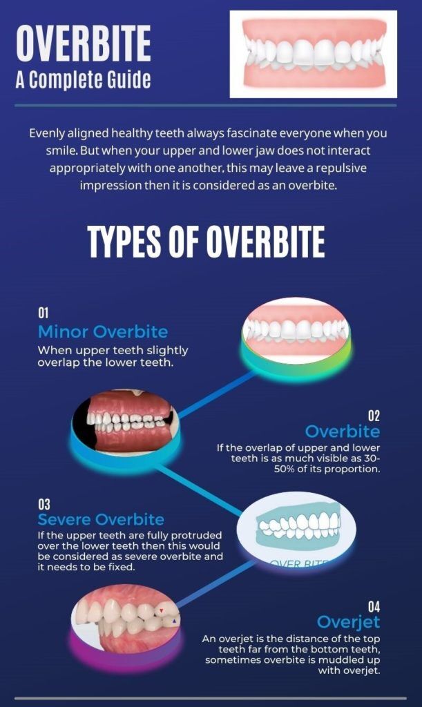 Types Of Overbite