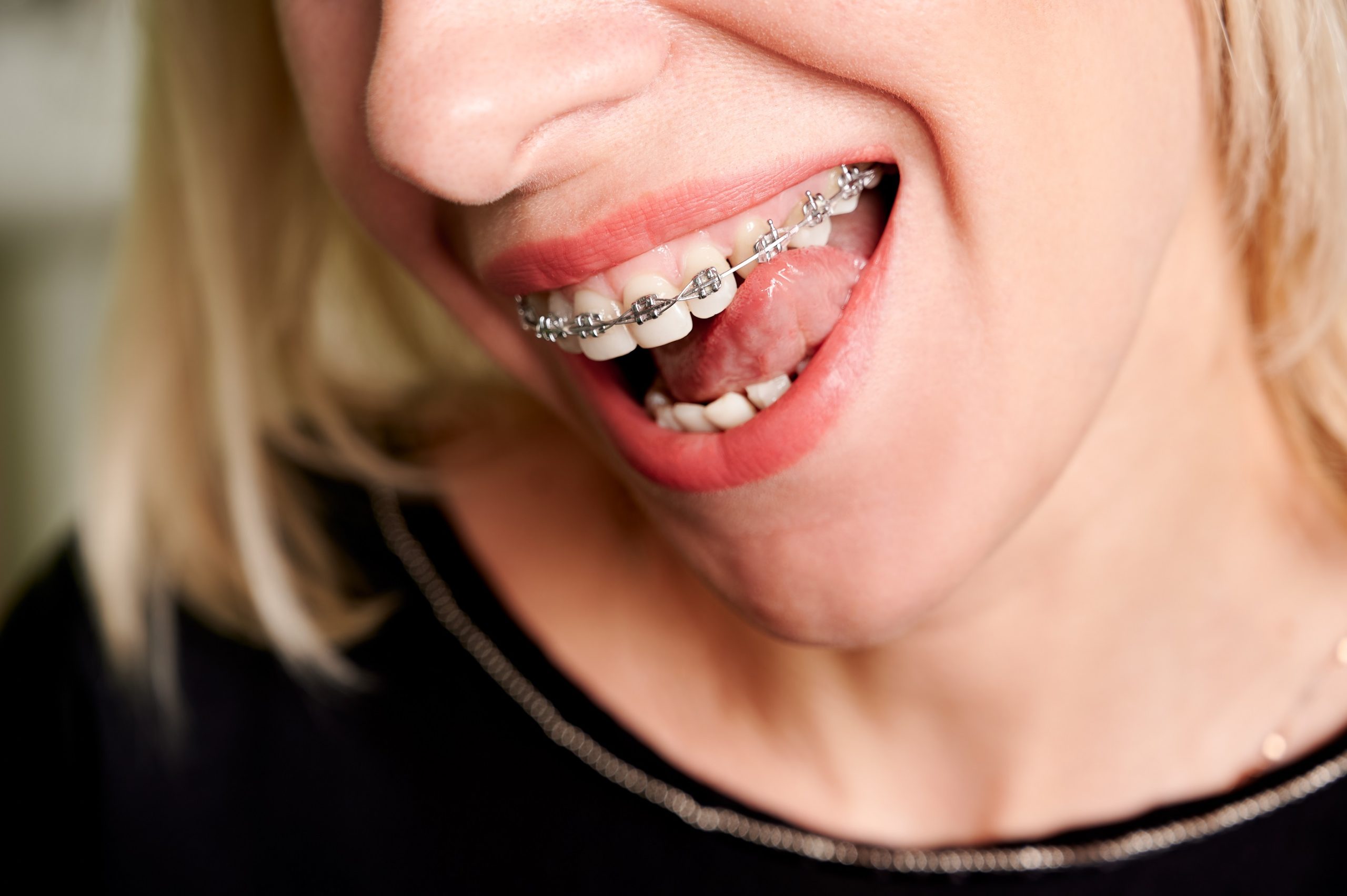 metal spacers for braces