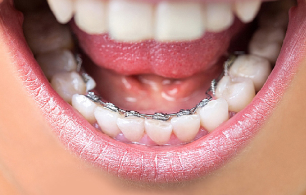FAQs for Lingual Braces