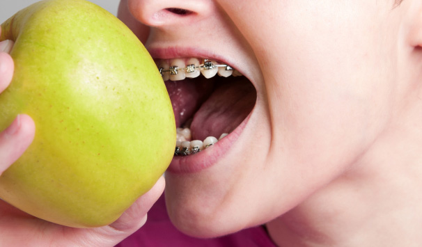 Avoid Foods with Braces