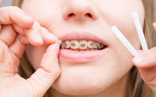 Elastics (Rubber Bands) in Orthodontic Treatment, Pediatric Dentistry &  Orthodontics of Central Iowa