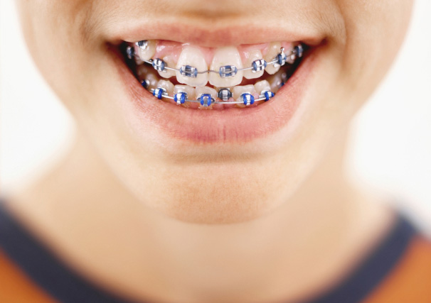 Orthodontic Treatments Covered By Public Aid in Illinois