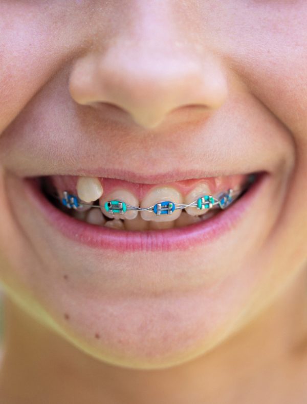 Phase 1 vs Phase 2 Orthodontics Orthodontic Experts