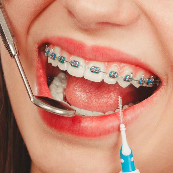 Braces Colors For Adults