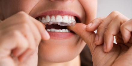 Orthodontic Aligners Treatment for Adults