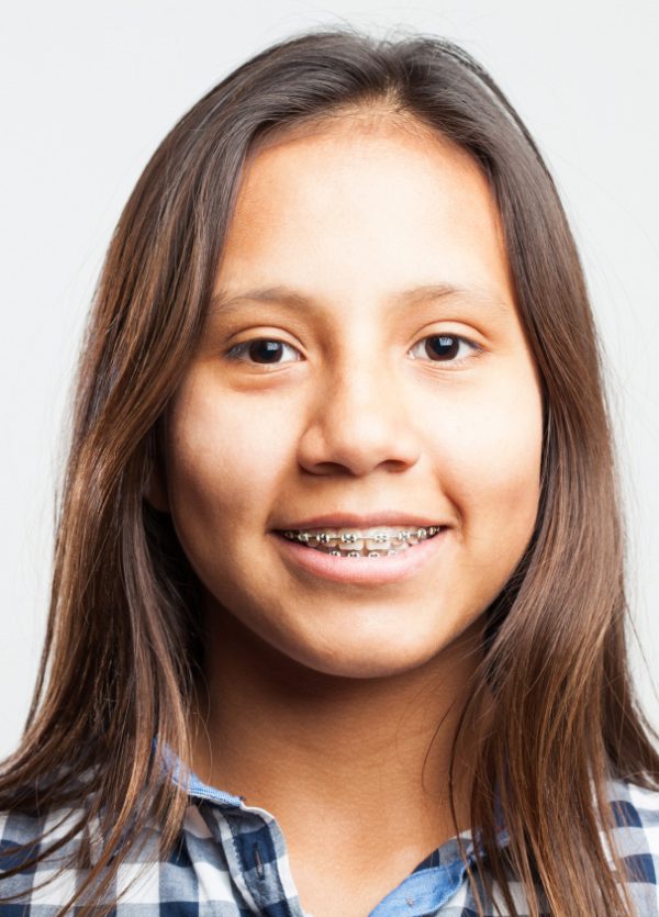 Braces with Hoosier Medicaid Top Orthodontist Braces, Clear Aligners