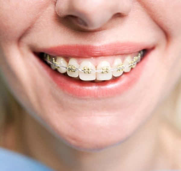 Gold Braces Affordable Iconix Braces Orthodontic Experts , IL