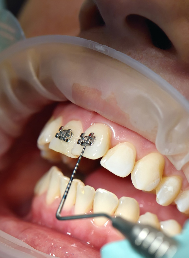 Medicaid braces deals