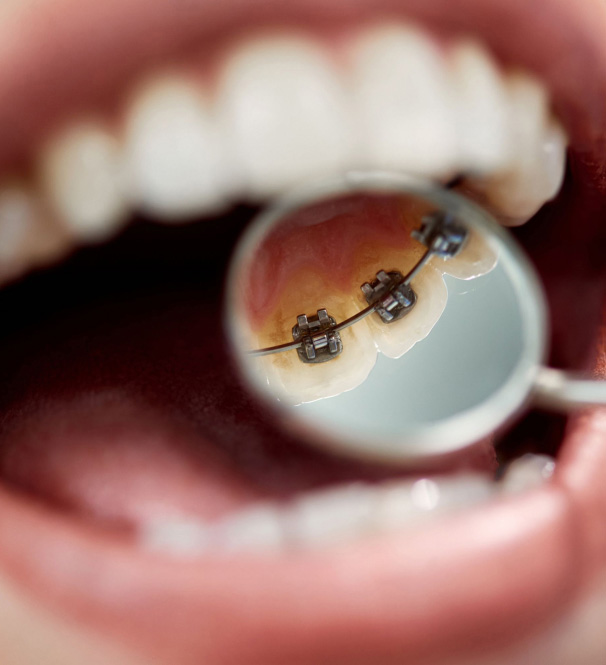 How Quickly Do Lingual Braces Work?