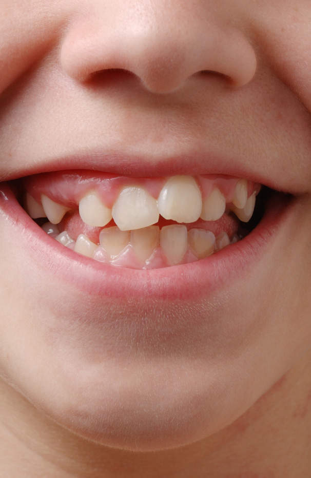 Causes of Misaligned Teeth