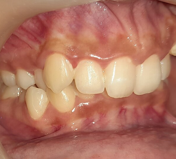 normal teeth bite