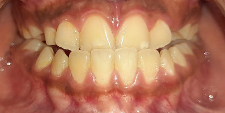 Anterior Crossbite