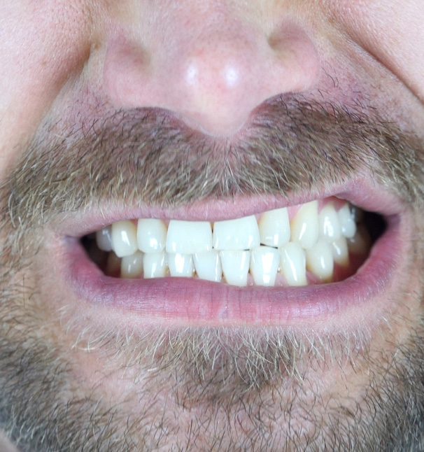 Causes Of An Crossbite