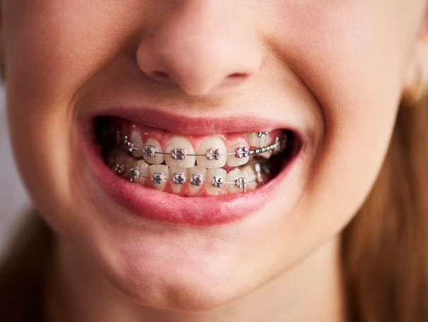 dental issues caused by crooked teeth