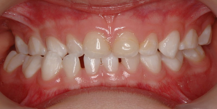 Posterior Crossbite