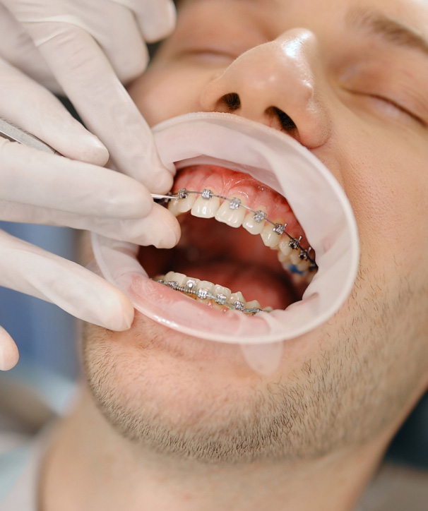 duration & cost of braces for adults