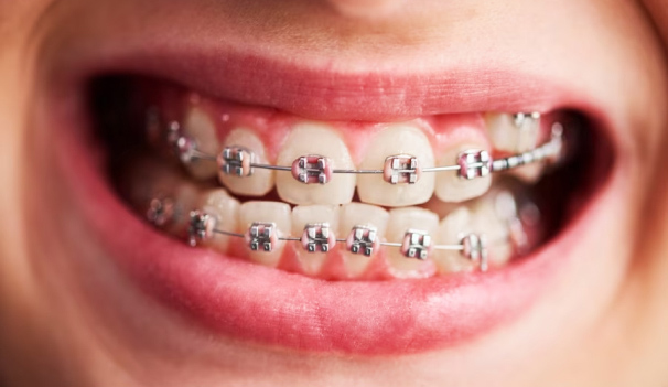 Crooked Teeth FAQs