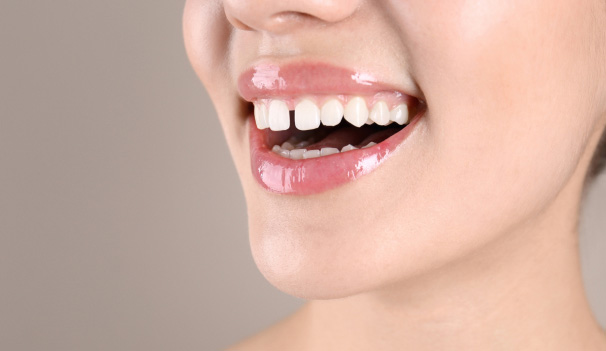 Spaced Teeth FAQs