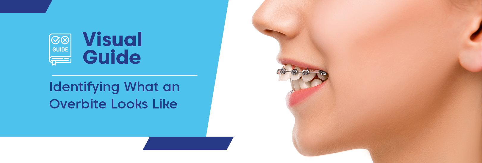 Overbite Correction: Can Braces Fix an Overbite?