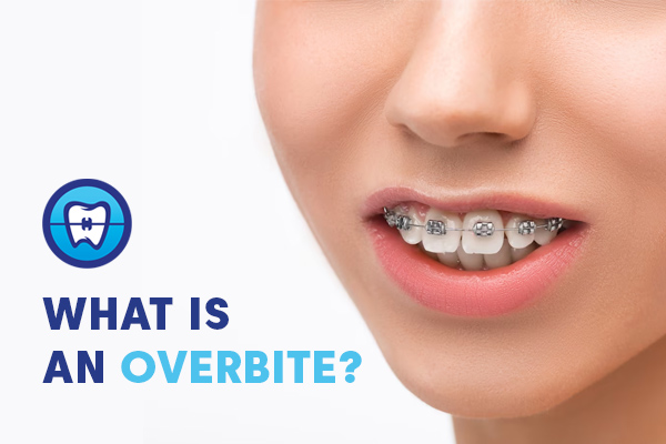 what is an overbite in teeth