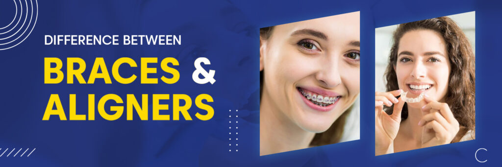 aligners vs braces