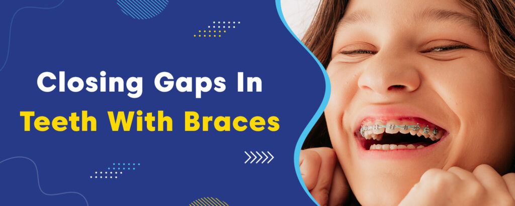 braces for gaps