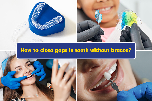 Close Gaps In Teeth Without Braces
