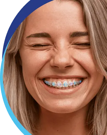 Ceramic braces
