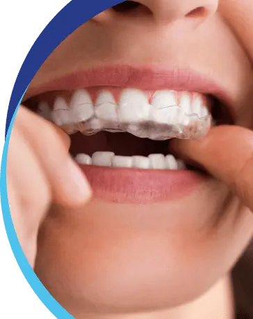 Clear Aligners