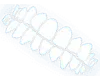 Crossbite