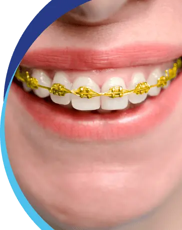 Gold Braces