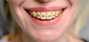 Gold Braces