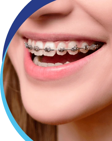 Metal Braces