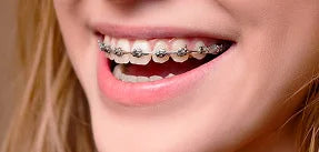 Metal Braces