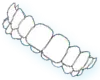 Overbite
