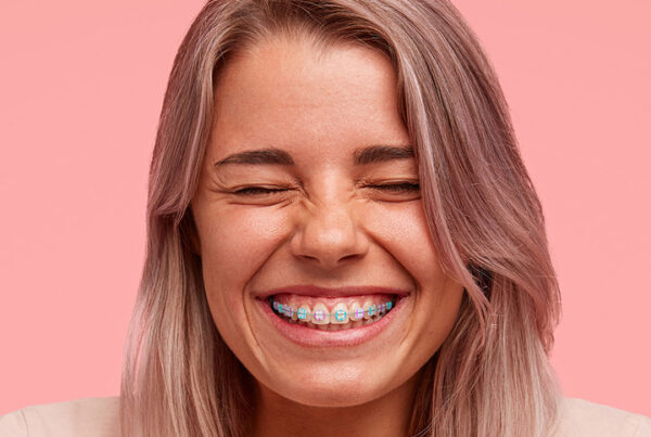 Ceramic Braces