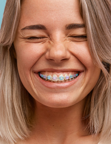Ceramic braces