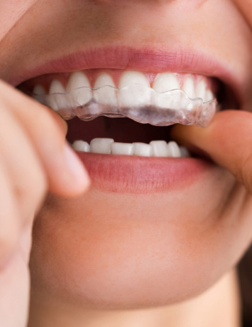 Clear Aligners