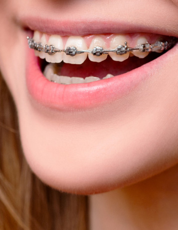 Metal Braces