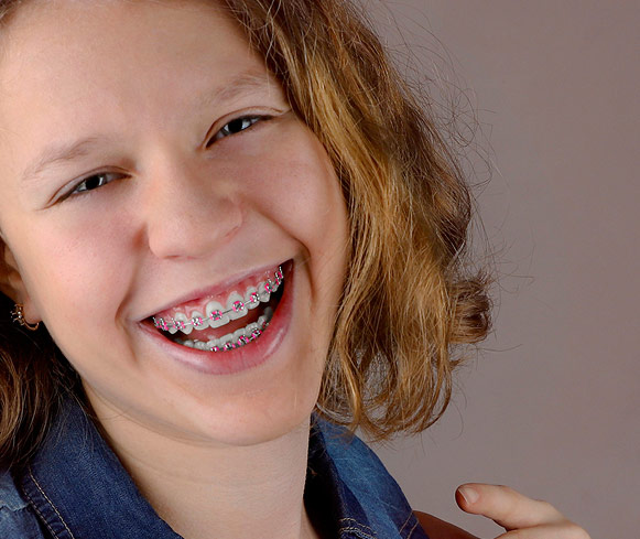 Braces color for school