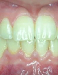 After Orthodontic Treatment