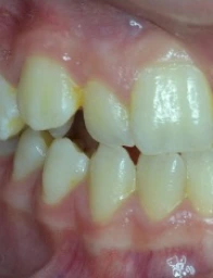 Before Orthodontic Treatment