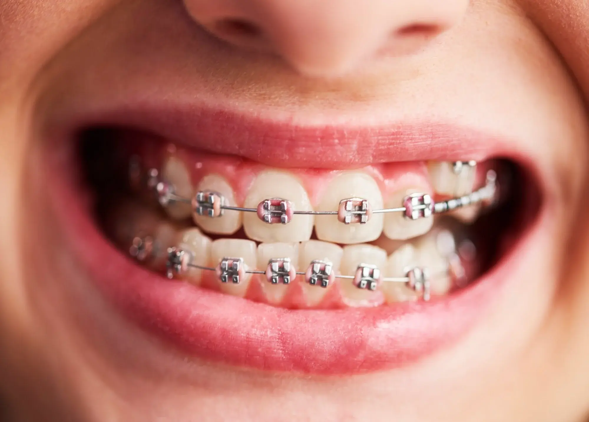 Girl wearing Rose Gold Braces