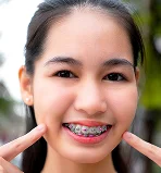 Girl wearing Ceramic Braces