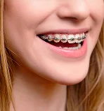 Girl wearing  Self Ligating Braces