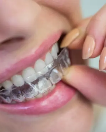 Expectations of Clear Aligners Treatment