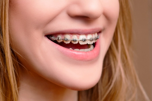 Cost differences between braces types
