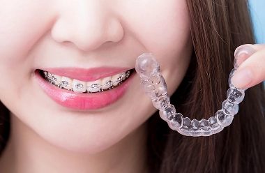 Fixed braces vs removable aligners