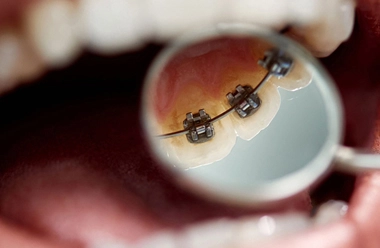 How do braces work?